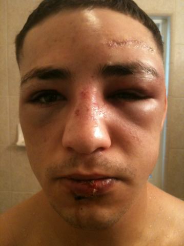 Diego Sanchez Recovering from BJ Penn