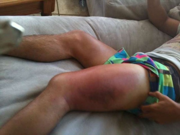 samvittighed drag pelleten WEC 48 Aftermath Pictures of Urijah Faber After Some Lethal Leg Kicks From Jose  Aldo | MMA Fight