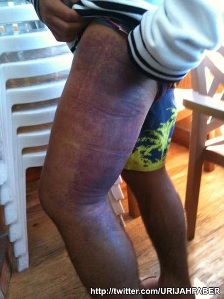 Pic Leg Several Days After WEC 48 Fight Against Jose | MMA Fight